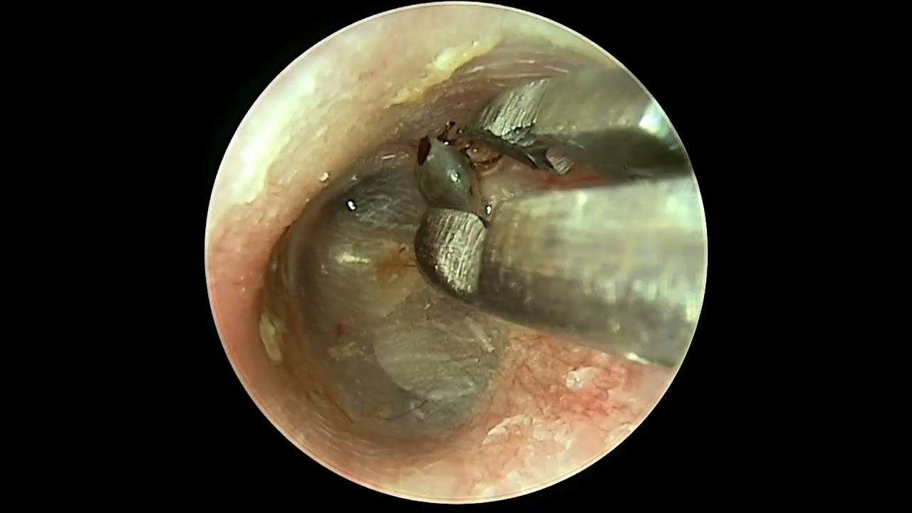 耳掃除 耳かき  ear cleaninglimpeza de ouvido earwaxcera de ouvido 귀소지 89
