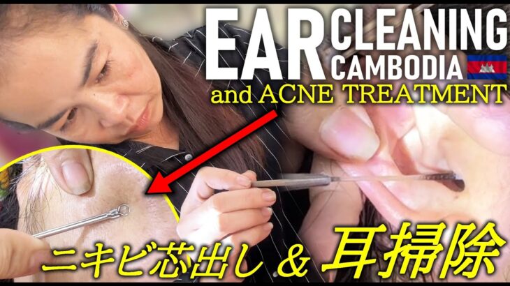 耳かき/ニキビ芯出し/カンボジア床屋/理髪店 Barber/Acne/Ear Cleaning